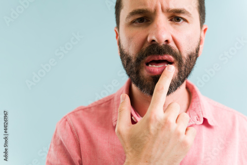 Hispanic man suffering from chapped lips