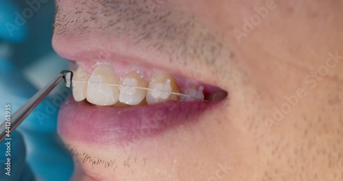 Close-up male mouth with ceramic braces on teeth and orthodontist hand in blue gloves using dental forceps while putting black ligature ties on braces. The patient is having orthodontic treatment.