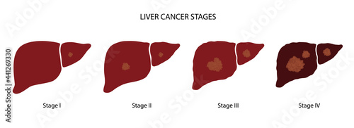 Liver disease concept