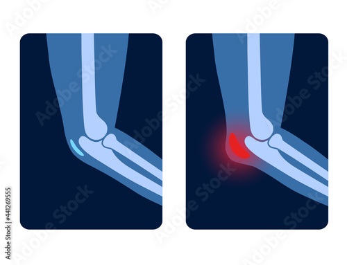 Bursitis Arms concept
