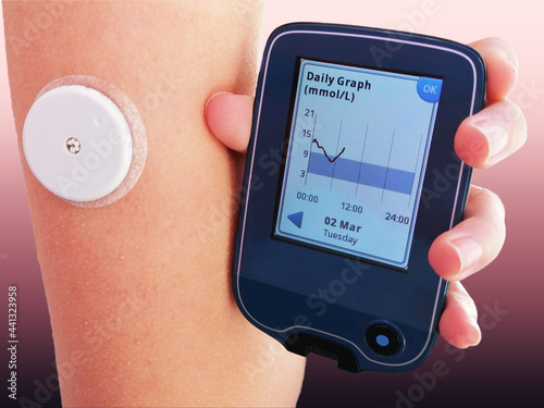 Картината върху платно Closeup od device for continuous glucose monitoring in blood – CGM