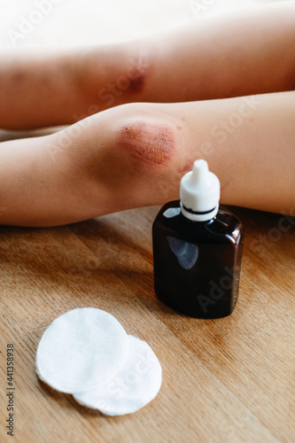 Children injury. Deep scratches on the skin on the kids knee. Wounds, scratches, abrasions on the child leg. Bottle of antiseptic and sponges to clean the wound  photo