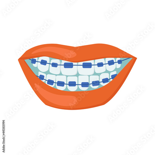 dental braces, orthodontic instrument for teeth straightening