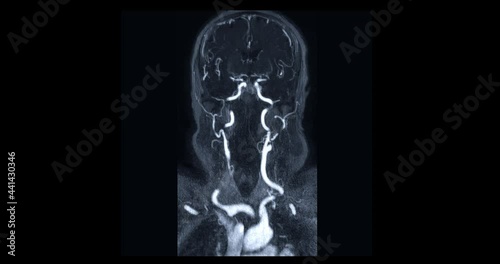 Contrasted of MRA Brain or Magnetic resonance angiography of the brain  Coronal MIP view showing cerebral artery and common carotid artery. photo