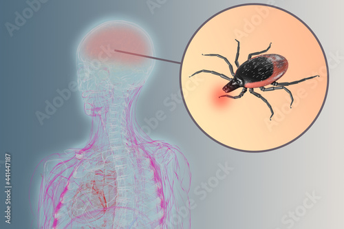 The defeat of the brain with tick-borne encephallitis virus. Dangerous insects that can infect humans with a virus. 3d rendering