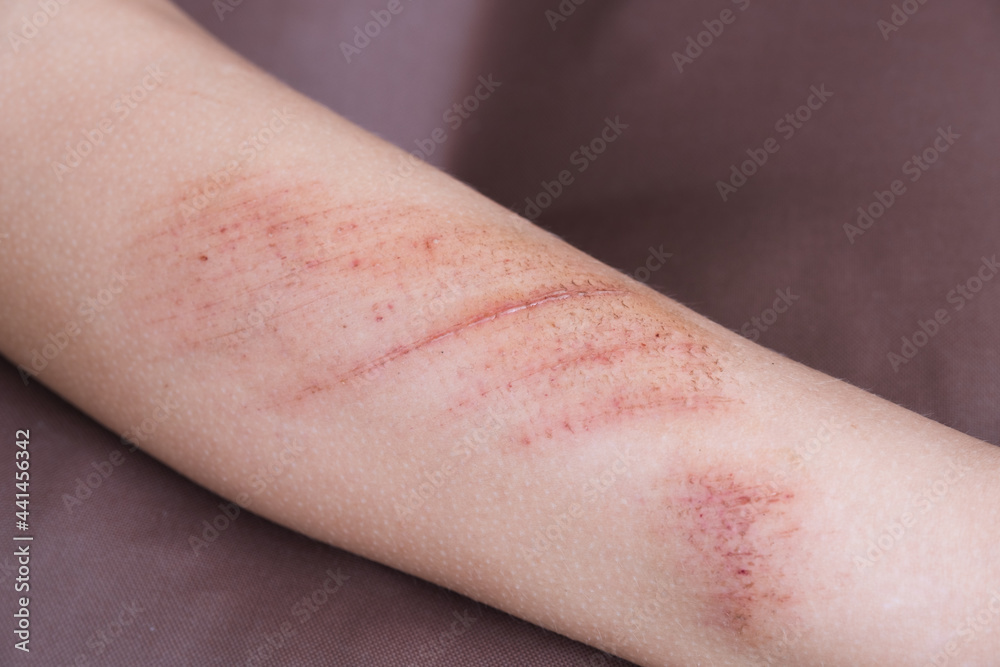 Fototapeta premium Wounds, scratches and abrasions on skin of child leg. Children injury.