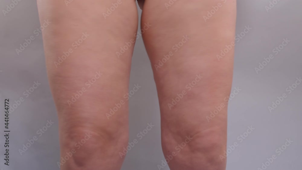 Movement with fat on a woman's legs. She shakes hips, shows her leg size with hand. Consequences of a sedentary lifestyle.