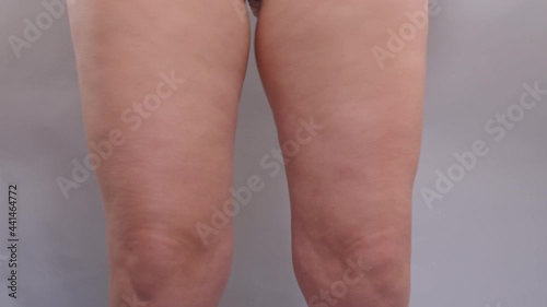 Movement with fat on a woman's legs. She shakes hips, shows her leg size with hand. Consequences of a sedentary lifestyle.