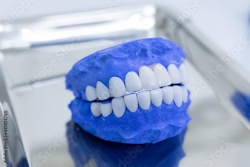 Wallpaper Mural Dental veneers are lying on a blue background in the laboratory. Torontodigital.ca