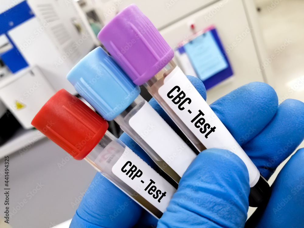Scientist holding test tube with sample for CBC and coagulation and CRP