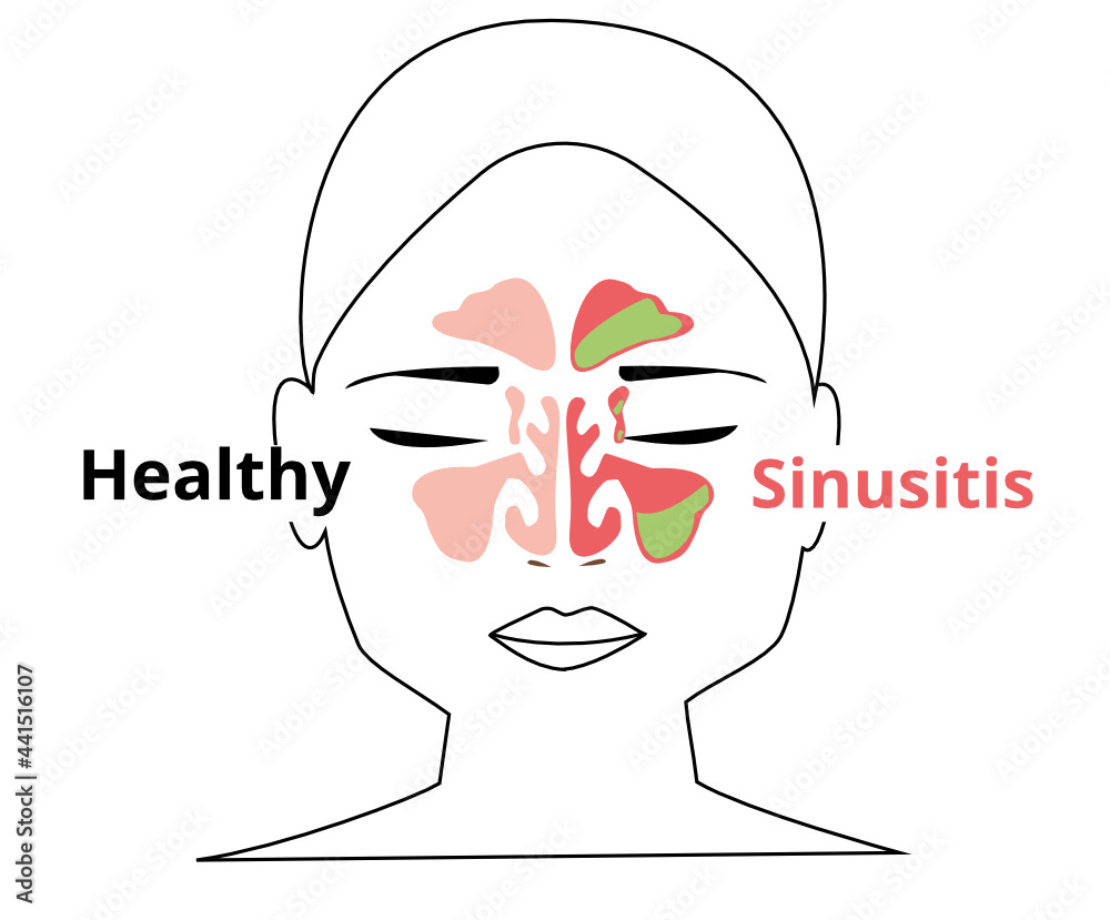 Sinusitis medical treatment. Nasal sinus. Healthy and inflammation