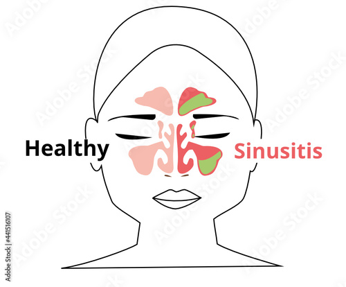 Sinusitis medical treatment. Nasal sinus. Healthy and inflammation sinus. Nasal diseases. Sinusitis, sinus infection diagnosis medical infographic design. Vector Eps.8
