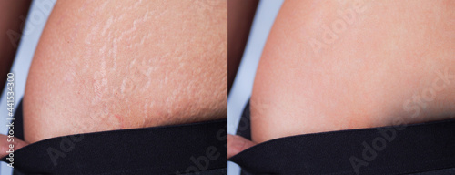 Quadro su tela Image before and after skin stretch marks removal treatment on women abdomen after pregnancy