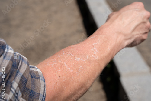 Dry flaky skin on a man's hand after sunburn