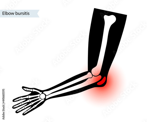 Student elbow bursitis