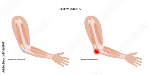 Student elbow bursitis