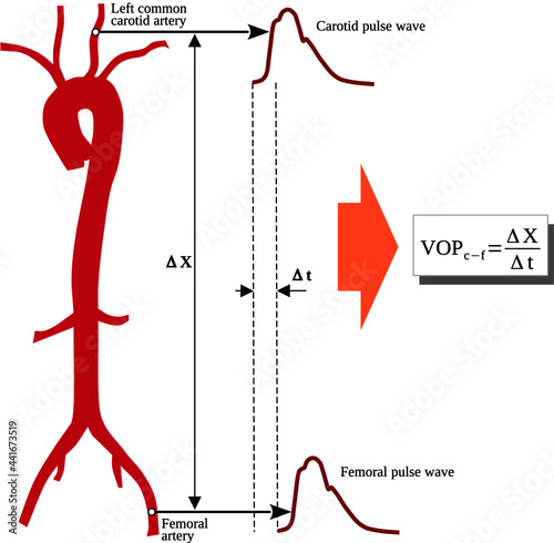 Pulse Wave Velocity (PWV) is a measure of arterial stiffness and is defined the velocity at which the blood pressure pulse wave propagates through the circulatory system