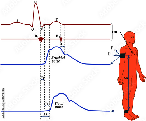 Cardio‐ankle vascular index (CAVI) is a marker of arterial stiffness that assess arterial stiffness from the femoral artery to tibial artery