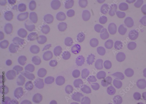 Blood parasite ring form Malaria infected red blood cells.