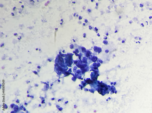 Cervical cancer cells. Atypical glandular cells,Adenocarcinoma of cervix,Pap smear. pap's. cervical cancer diagnosis,microscopic 100x view,