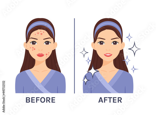 Cute brunette woman with pimples on her face. Acne Treatment. Before after. Problematic and clear skin. Healthy happy lady. Flat cartoon color style. White background. Vector stock illustration.