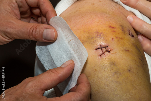 Lésions de la coiffe des rotateurs