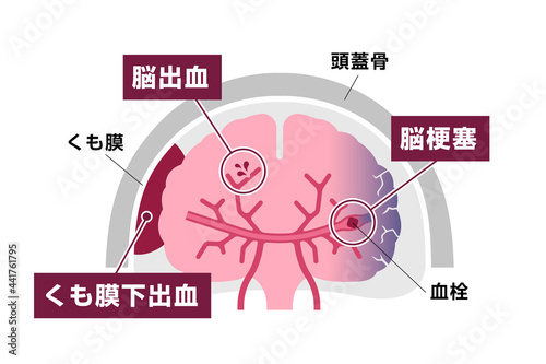 脳卒中 (脳梗塞・脳出血・くも膜下出血) の原因と症状　図解ベクターイラスト