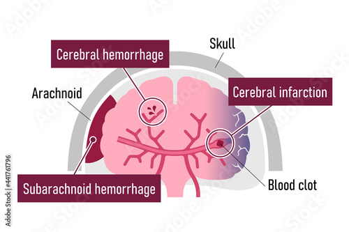 Types of human brain stroke vector illustration