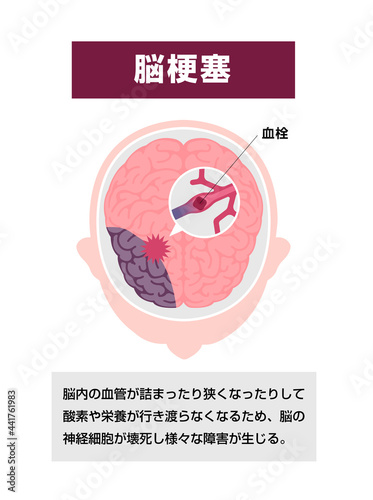 脳梗塞の原因と症状　図解ベクターイラスト