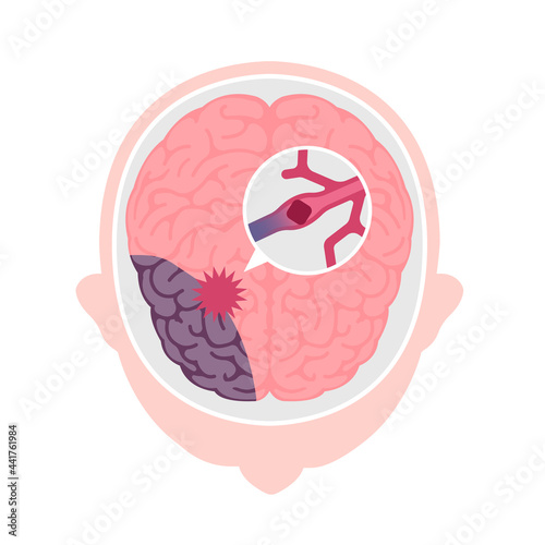 Types of human brain stroke vector illustration | Cerebral infarction