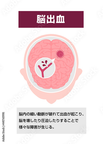 脳出血の原因と症状　図解ベクターイラスト