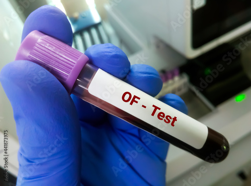 Scientist hold blood sample for OF (Osmotic Fragility) test, hematology