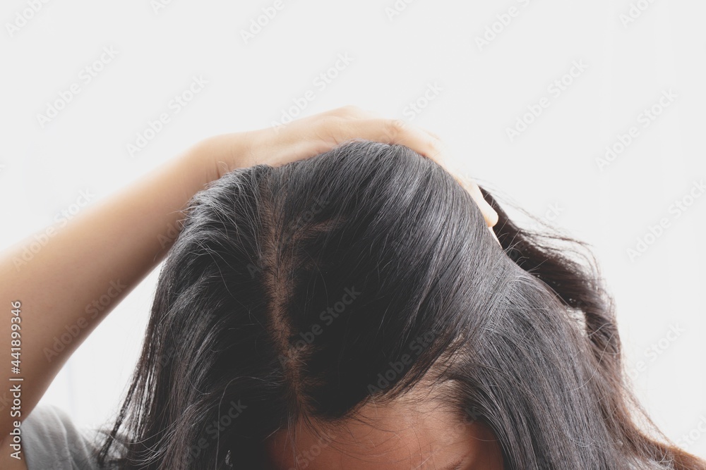 Fototapeta premium Women are allergic to shampoo causing hair loss and dandruff.