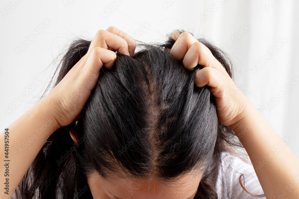 Fototapeta premium Women allergic to shampoo causing hair loss, baldness, dandruff