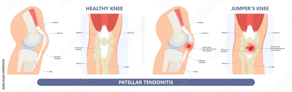 patella pain cap knee tear Torn injury Swelling bone leg exercise muscle  jumper's runner's bursitis tendon tibia Anterior Cruciate Ligament ACL  sport femur painful it band rupture Trauma joint cyst Stock Vector