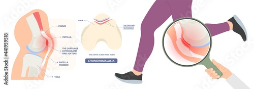 patella pain cap knee tear Torn injury Swelling bone leg exercise muscle jumper's runner's bursitis tendon tibia Anterior Cruciate Ligament ACL sport  femur painful it band rupture Trauma joint cyst