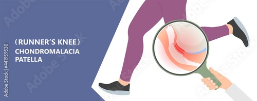 patella pain cap knee tear Torn injury Swelling bone leg exercise muscle jumper's runner's bursitis tendon tibia Anterior Cruciate Ligament ACL sport  femur painful it band rupture Trauma joint cyst