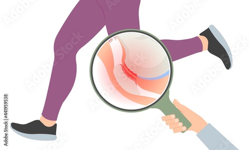 patella pain cap knee tear Torn injury Swelling bone leg exercise muscle jumper's runner's bursitis tendon tibia Anterior Cruciate Ligament ACL sport  femur painful it band rupture Trauma joint cyst