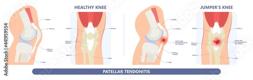 patella pain cap knee tear Torn injury Swelling bone leg exercise muscle jumper's runner's bursitis tendon tibia Anterior Cruciate Ligament ACL sport  femur painful it band rupture Trauma joint cyst