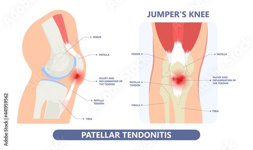 patella pain cap knee tear Torn injury Swelling bone leg exercise muscle jumper's runner's bursitis tendon tibia Anterior Cruciate Ligament ACL sport  femur painful it band rupture Trauma joint cyst