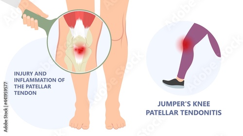 patella pain cap knee tear Torn injury Swelling bone leg exercise muscle jumper's runner's bursitis tendon tibia Anterior Cruciate Ligament ACL sport  femur painful it band rupture Trauma joint cyst