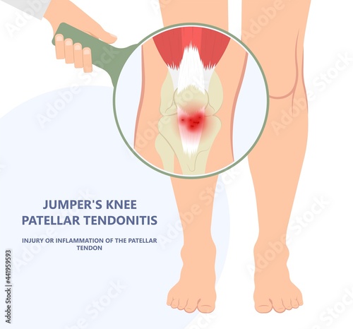 patella pain cap knee tear Torn injury Swelling bone leg exercise muscle jumper's runner's bursitis tendon tibia Anterior Cruciate Ligament ACL sport  femur painful it band rupture Trauma joint cyst