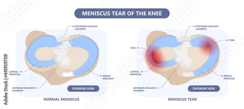 patella pain cap knee tear Torn injury Swelling bone leg exercise muscle jumper's runner's bursitis tendon tibia Anterior Cruciate Ligament ACL sport  femur painful it band rupture Trauma joint cyst