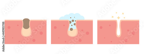 Cleaning clogged pores process flat illustration. Blackheads removal, skin cleaning foam, skincare. Can be used for topics like cosmetology, cosmetics. Shrinking and minimaizing face pores concept