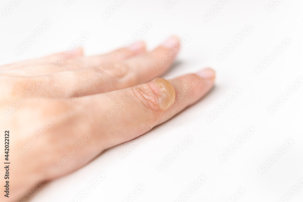There is a blister on woman's hand from a burn. Burn of the finger. A