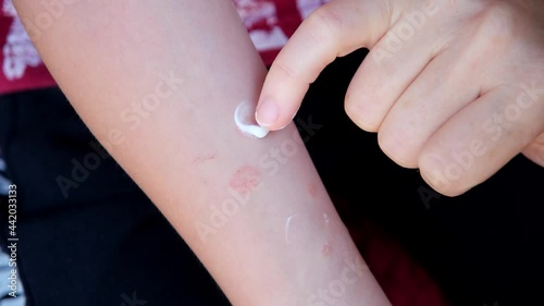 Ringworm on Arm with Hand. Cat disease. Mother applies cream to treat cat fungus on her child's arm. Skin problem. 