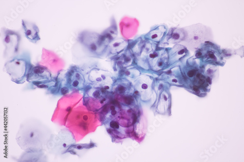 View in microscopic of koilocyte cell criteria of HPV (Human Papilloma virus) infection.Pap smear for woman.Medical background concept. photo