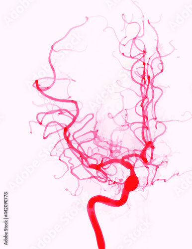 cerebral angiography or angiogram of internal carotid artery photo