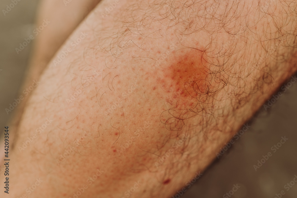 Simuliidae black fly bite mark on the leg below the knee Simuliidae black fly bite mark on the leg below the knee