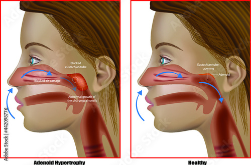 Adenoid hypertrophy, the abnormal growth of the pharyngeal tonsils. Adenoidectomy or Adenoid Removal. Eustachian Tube Dysfunction photo